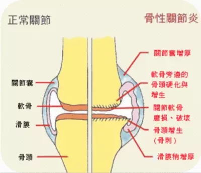 膝关节疼痛的原因